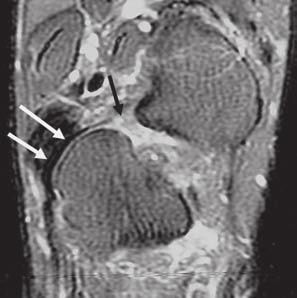 maléolo medial e insertándose en el sustentáculo del astrágalo. B. Imagen FSE-T2W coronal del tobillo (anterior a A).