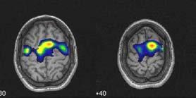 La PET (arriba a la izquierda) muestra una extensa hipoperfusión frontal derecha.