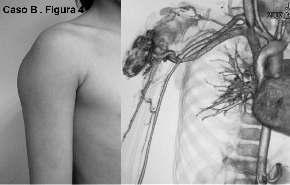 Figura : Arteriografía carotídea pre embolización mostrando hipervascularización capilar del hemangioma y marcado engrosamiento de la arteria carótida externa.