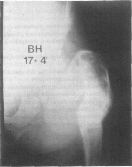 SUMMARY Fibrous dysplasia of bone is a process in which fibrous tissue containing osteoblastic immature bone, proliferates and destroys normal cancellous bone and marrow.