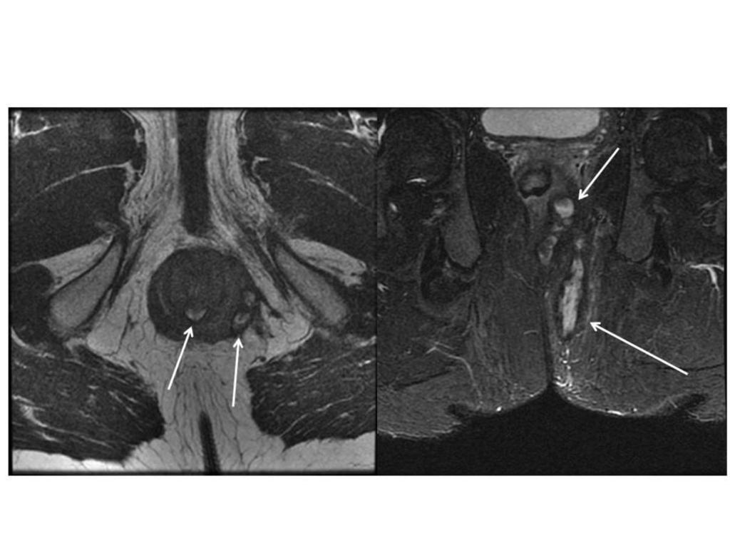 Fig. 11: Fistula grado 4: Imágenes de RM potenciadas en T2 ( izquierda axial sin saturación de la grasa y derecha coronal con saturación de