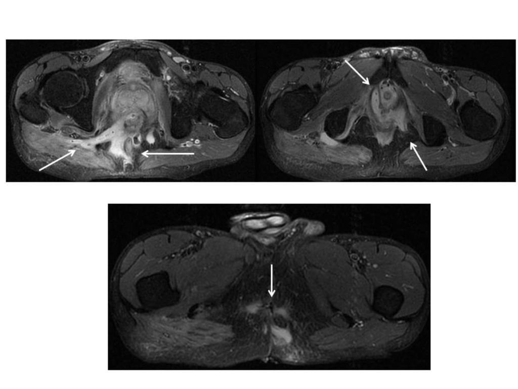 Fig. 15: Fistula grado 5: Paciente con enfermedad de Crohn.