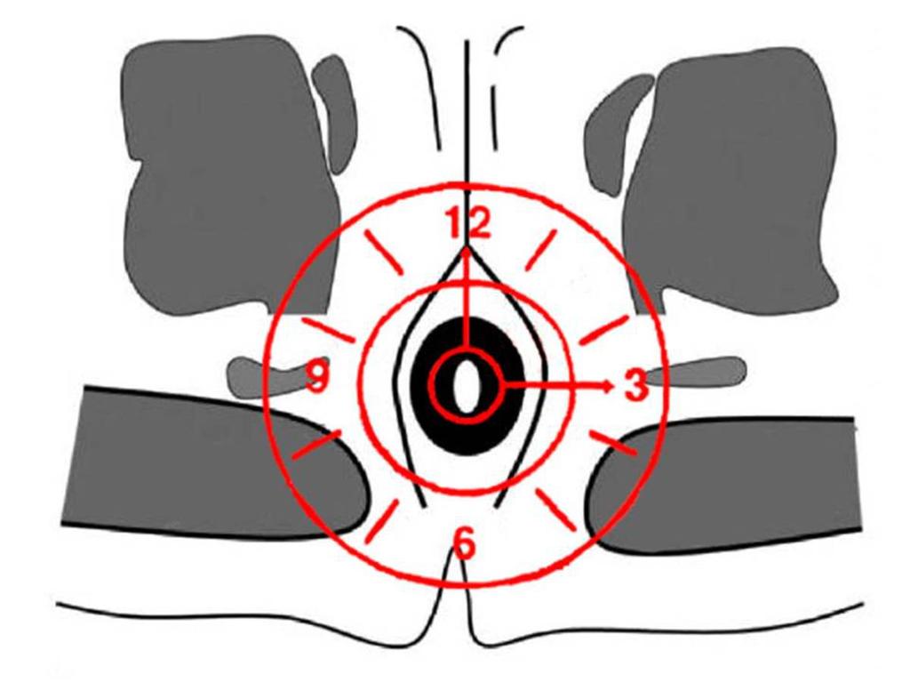 Fig. 3: Diagrama del "reloj anal" usado para la adecuada localización de las fistulas.