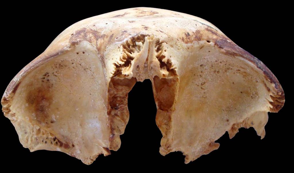 FRONTAL (Vista inferior) Escotadura frontal interna Agujero supraorbitario Espina nasal Escotadura