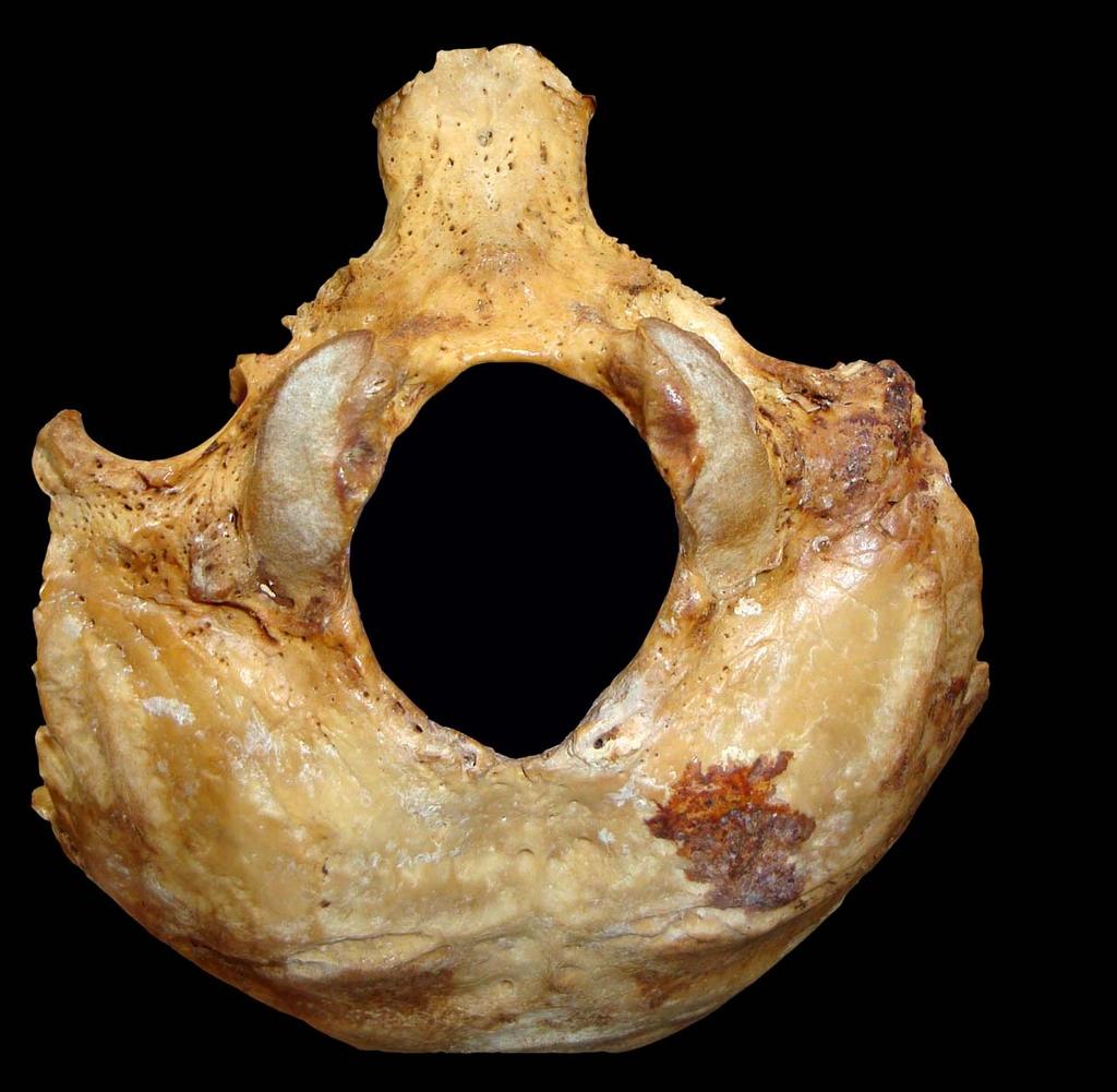 OCCIPITAL: Masas Laterales-Apófisis basilar (Vista exocraneal) 1 2 7 3 4 1- Fosita faringea 2-.