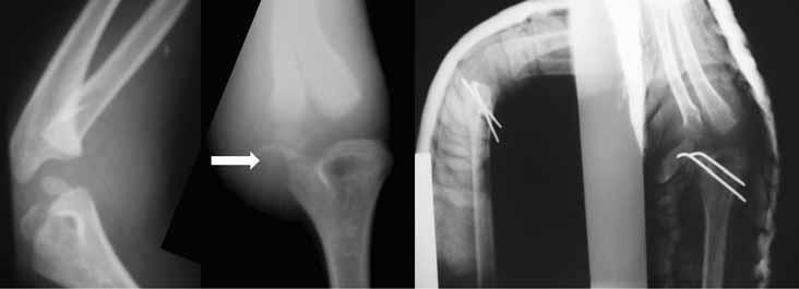 Ortho-tips Vol. 5 No. 3 2009 las fracturas del cóndilo lateral del húmero van a requerir de reducción abierta o cerrada y fijación interna (Figuras 9 y 10).