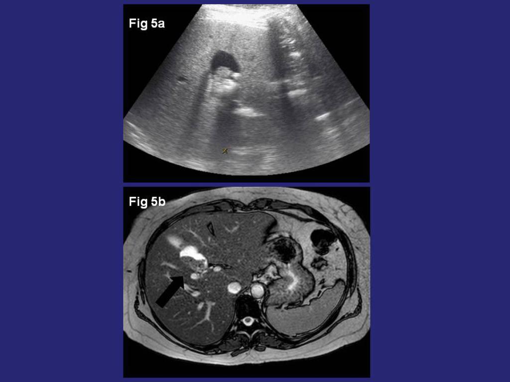 Fig. 5: Mujer de 36 años. La ecografía (fig. 5a) muestra una lesión quística compleja, con presencia de una lesión ecogénica. En la imagen de Resonancia (fig.