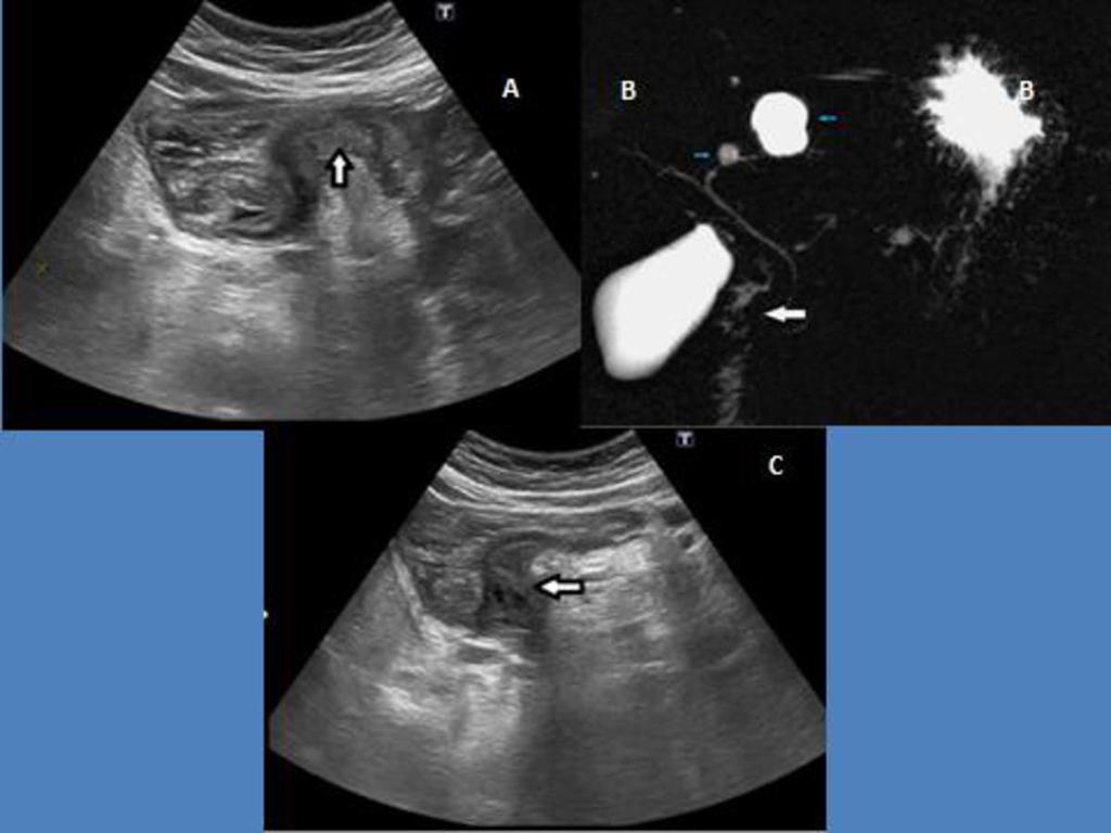 cabeza del páncreas (forma segmentaria) Fig. 2: Figura. 2 Paciente de 56 años con dolor epigástrico y vómitos.