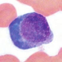 25 Linfocitos atípicos En esta muestra se identificaron al microscopio un pequeño número de granulocitos inmaduros y linfocitos atípicos.