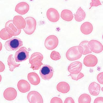 Casos de anormalidades en la línea de eritrocitos Presencia de eritroblastos (N por sus siglas en inglés) Información del XS1000i Datos de análisis del XS1000i RDWSD RDWCV PLCR 30.35 2.86 79 24.6 86.