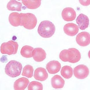 Casos de anormalidades en la línea de eritrocitos Presencia de eritroblastos muestra con punteado basófilo Información del XS1000i Datos de análisis del XS1000i RDWSD RDWCV PLCR 8.94 2.56 76 26.4 103.
