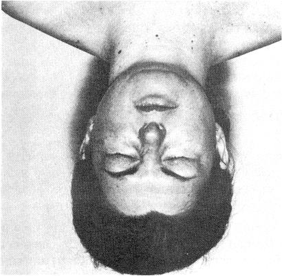 b) Para examinar la porción orbitaria: Pedir al paciente que cierre los ojos con fuerza. Los párpados se arrugan, formando pliegues profundos en el ángulo temporal del ojo.