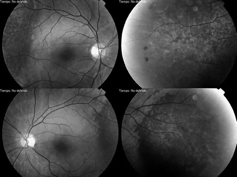 BERNAL MONTESDEOCA L, et al. Fig. 1: (Caso 1) Retinografía de ambos ojos. Depósitos drusenoides de lipofucsina en retina media y periférica con atrofia del epitelio retiniano incipiente bilateral.