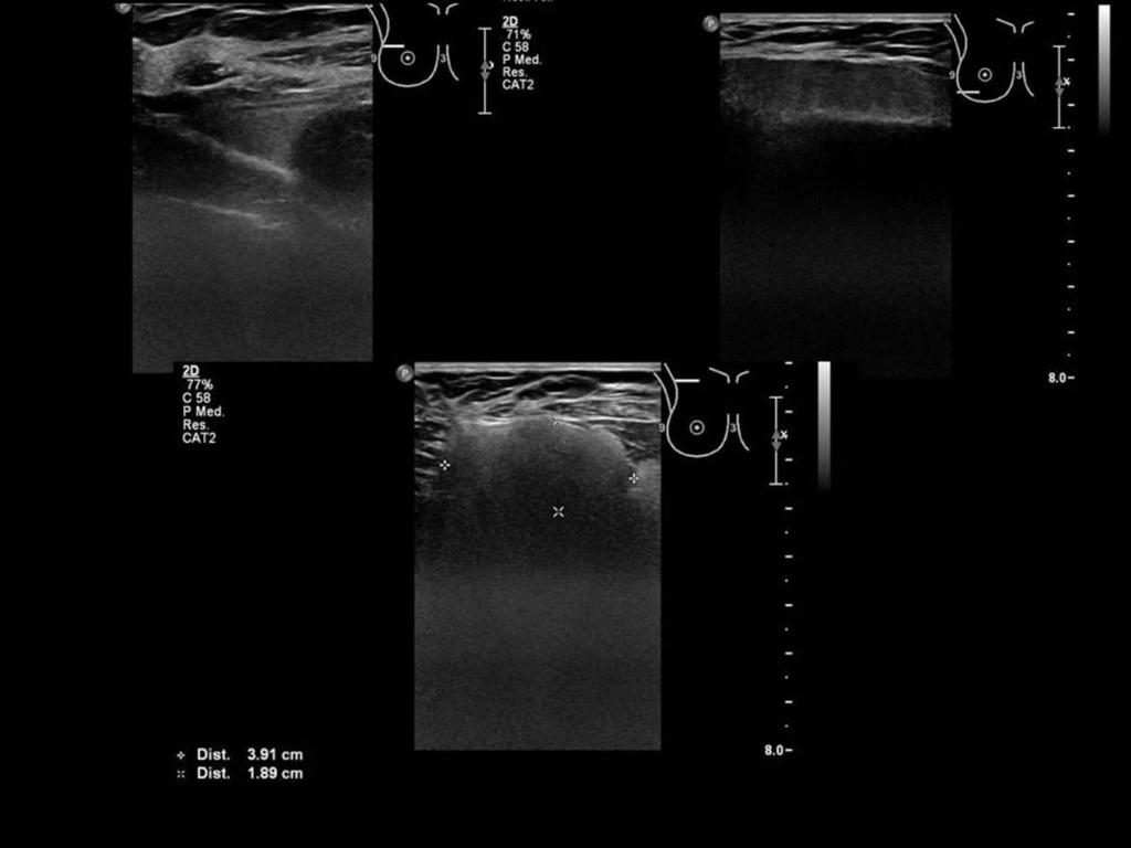 Fig. 11: Imagen de la izquierda: material hiperecogénico en cola axilar, fuera de la prótesis (silicona extruída).