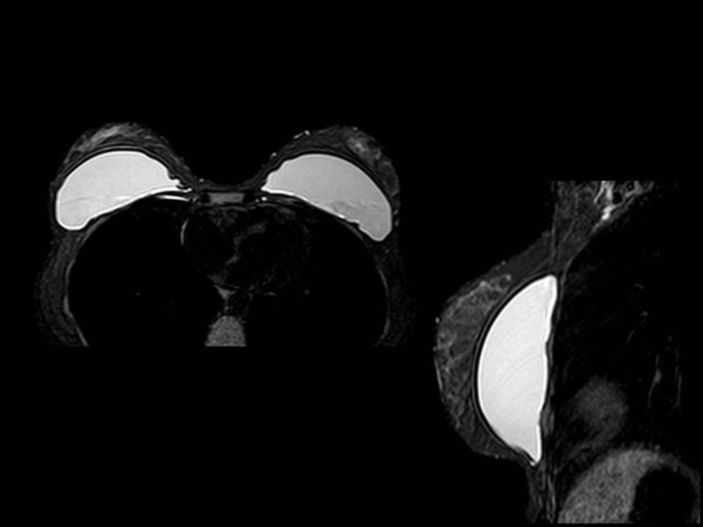 Fig. 16: Secuencias axial (imagen izquierda) y sagital de mama derecha (imagen de la derecha), donde se