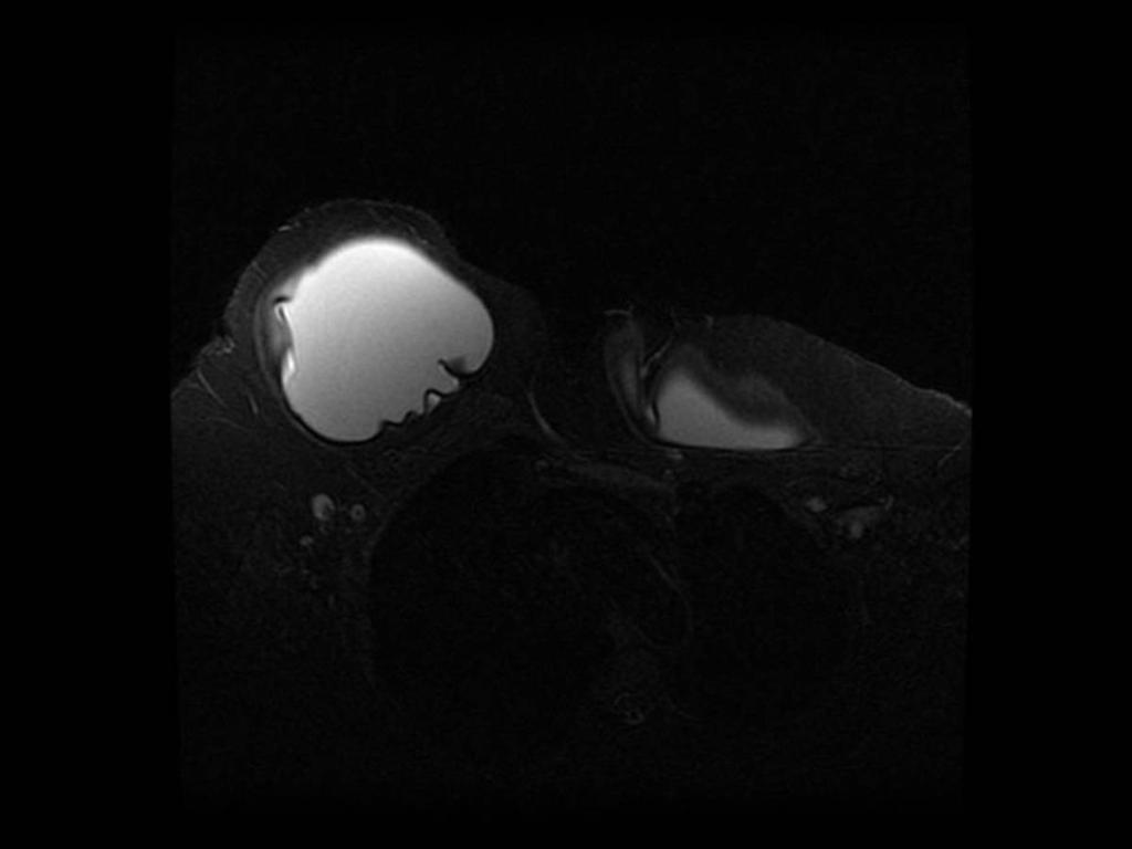 Fig. 21: Signo del linguini en la porción lateral de la prótesis de la mama