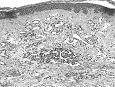 Figura 2. Microfotografía de la biopsia de piel que muestra hemangioma superficial con dilatación y proliferación capilar intraluminal con aspecto glomeruloide. HE, 100x.