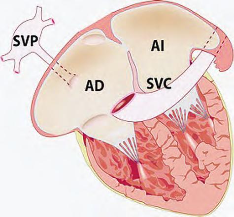 UNIDAD II Malformaciones de los atrios y de sus conexiones venosas La conexión anómala venosa en el seno coronario constituye el segundo lugar en frecuencia dentro de esta entidad.