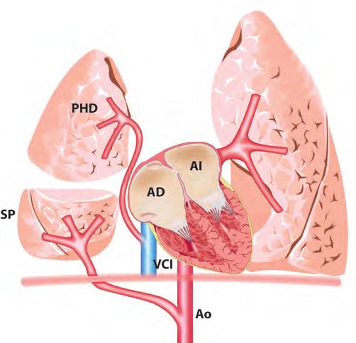 CAPÍTULO 8 Conexión anómala total de venas pulmonares la vena cava superior; en segundo lugar, las mismas venas conectan al atrio derecho; en tercer lugar, éstas desembocan a la vena del pulmón