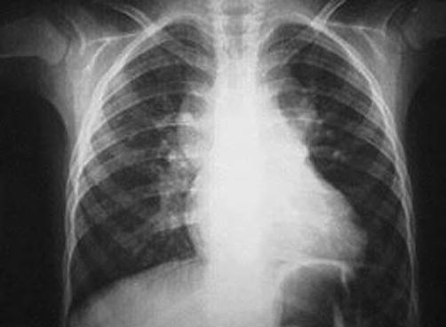 CAPÍTULO 8 Conexión anómala total de venas pulmonares derecho, el arco del tronco de la arteria pulmonar es prominente y el flujo pulmonar aumentado.