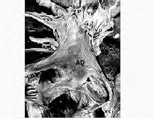 Imagen superior: pieza anatómica que muestra la conexión anómala total de las venas pulmonares (VP) al atrio derecho, cercana a la desembocadura de la vena cava superior (VCS) y vena cava inferior