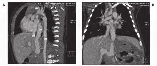 UNIDAD II Malformaciones de los atrios y de sus conexiones venosas la tomografía multicorte se usa medio de contraste y en resonancia magnética se requiere de apneas prolongadas, por lo que hay que