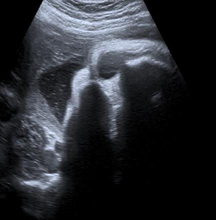 REVISIÓN CRÍTICA DEL PROBLEMA Figura 4. Posición de la cabeza fetal por ecografía suprapúbica. 1 2 3 1: Occípito transversa; 2: Occípito iliaca oblicua anterior; 3: Occípito iliaca oblicua posterior.