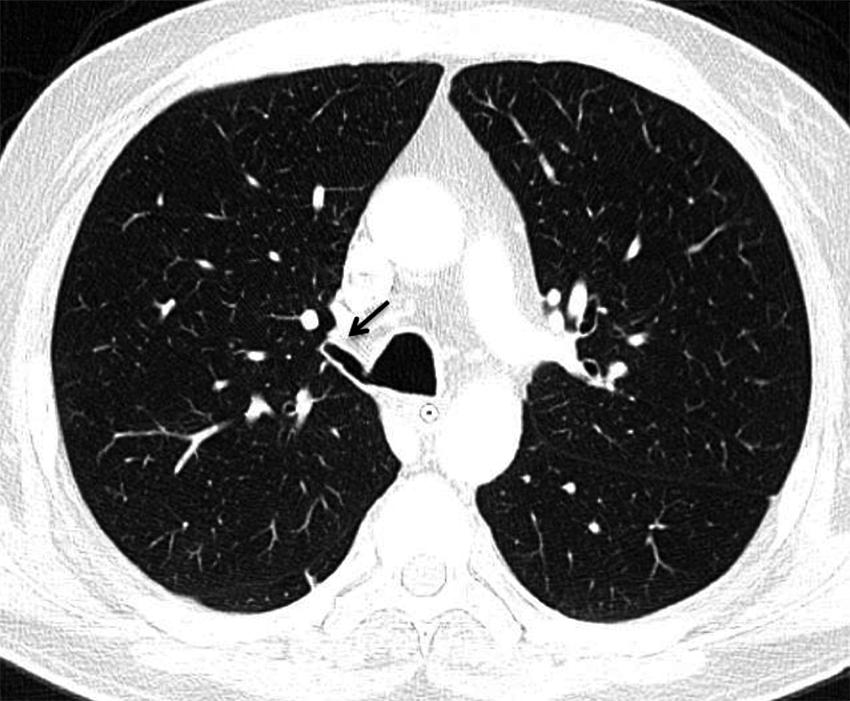 lobulillo pulmonar accesorio (cabeza de flecha) en región medial del pulmón derecho. Figura 6.