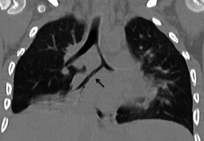 Bronquio cardíaco accesorio y otras variantes anatómicas bronquiales Figura 11. Reconstrucción coronal de tomografía computada de tórax.