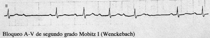 C. Tipo I o Wenckebach: Se caracteriza por un alargamiento progresivo del intervalo PR hasta que un impulso auricular no depolariza los ventrículos apareciendo una pausa.