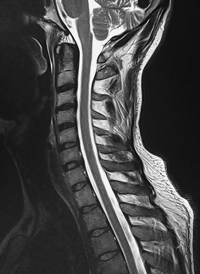 266 Columna vertebral Craneal Ventral Dorsal Caudal Foramen magno 2 Músculo trapecio