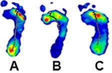 Pedobarographic Analysis Following Ponseti Treatment for Congenital Clubfoot: Análisis Pedobarográfico después del Tratamiento de Ponseti para el Pie Equino Varo Congénito: Exámen pedobarográfico:
