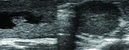 Gestación de 33 días con cuerpo lúteo GESTACIÓN DE 42 DÍAS La gestación ocupa los dos cuernos, el embrión de unalongitud de 24 mm todavía se puede encontrar en elcuerno ipsilateral.