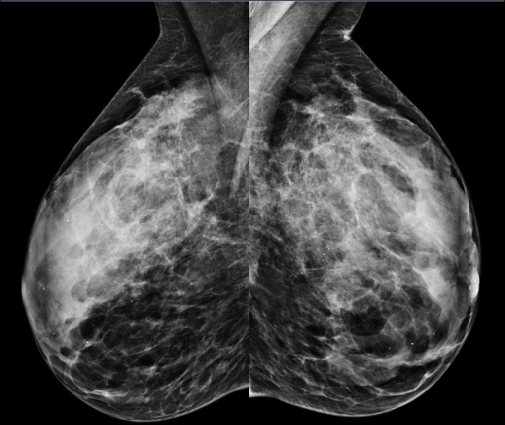 Fig. 9: Mastopatía lúpica. Mamografía bilateral, proyecciones OML.