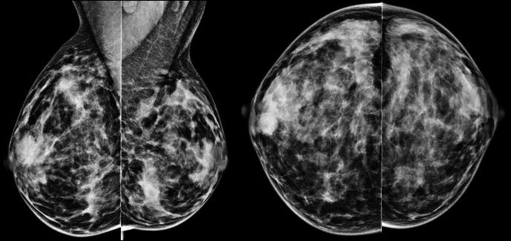Derecha: los hallazgos de mamografía se corresponden ecograficamente con un área de distorsión con zonas hipoecoicas internas.
