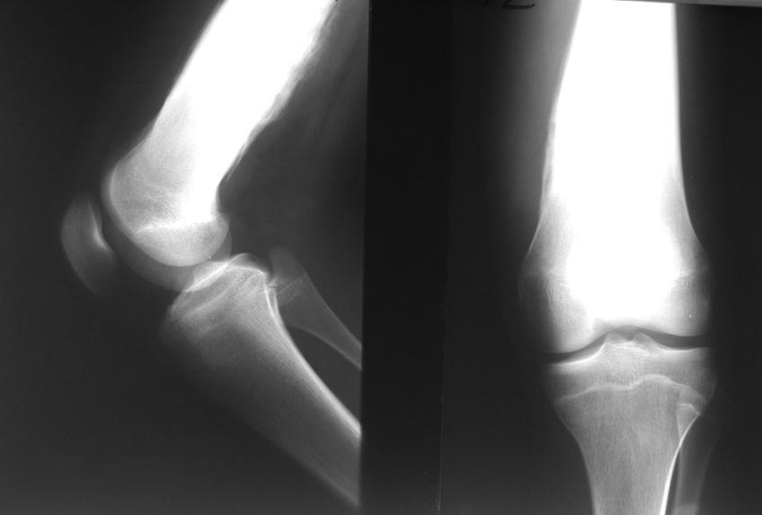 Osteomielitis subaguda: Se inicia el proceso con dolor leve que en ocasiones es intermitente con una