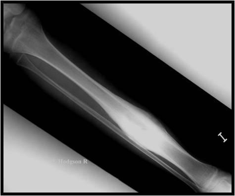 Caso anterior: Gammagrafía ósea con gran captación patológica en tercio distal de fémur derecho (foto del autor) Osteomielitis crónica: Es la consecuencia de la existencia de un equilibrio entre el