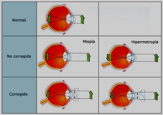 9. Alteraciones oculares Catarata: Se denomina así a las enfermedades que provocan opacidad del cristalino, hecho que conduce a la ceguera por imposibilidad de atravesar la luz.