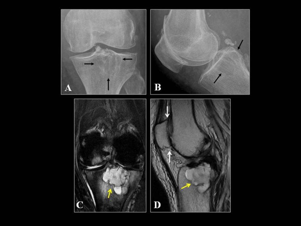 Fig. 12: Rodilla en paciente con artropatía por DCPC.
