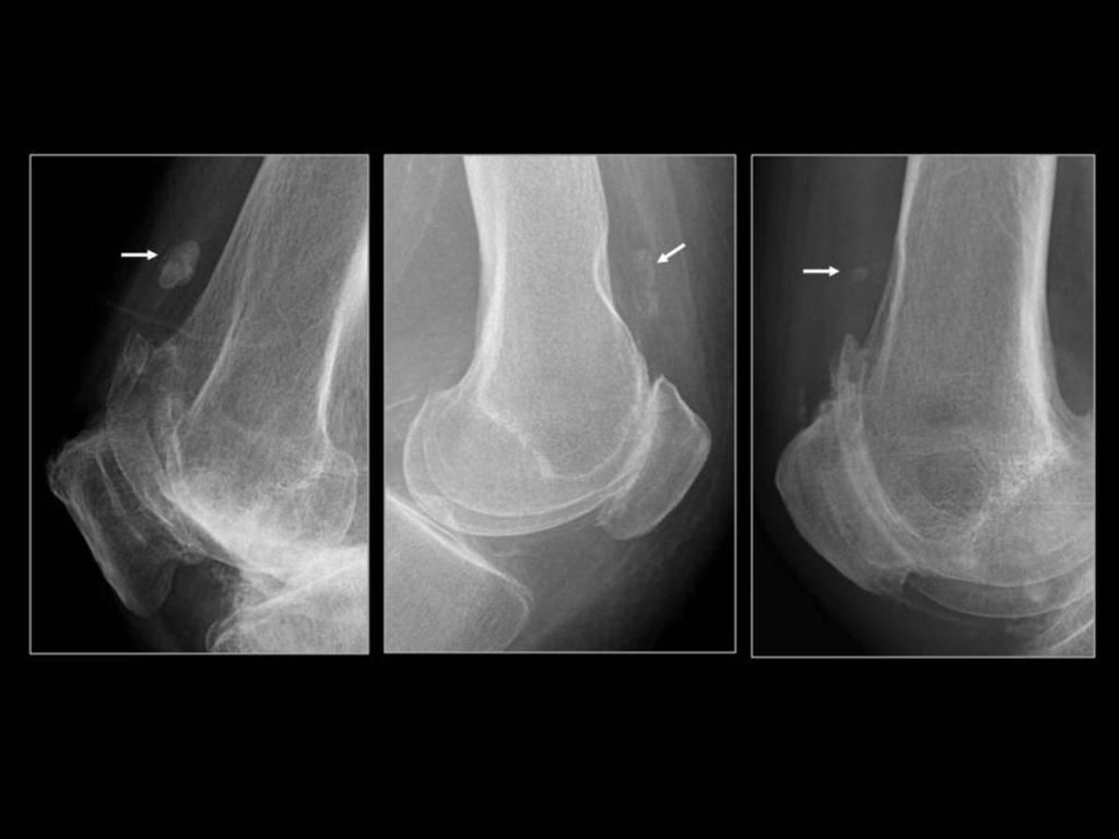 Fig. 18: Rodillas en pacientes con artropatía por DCPC.