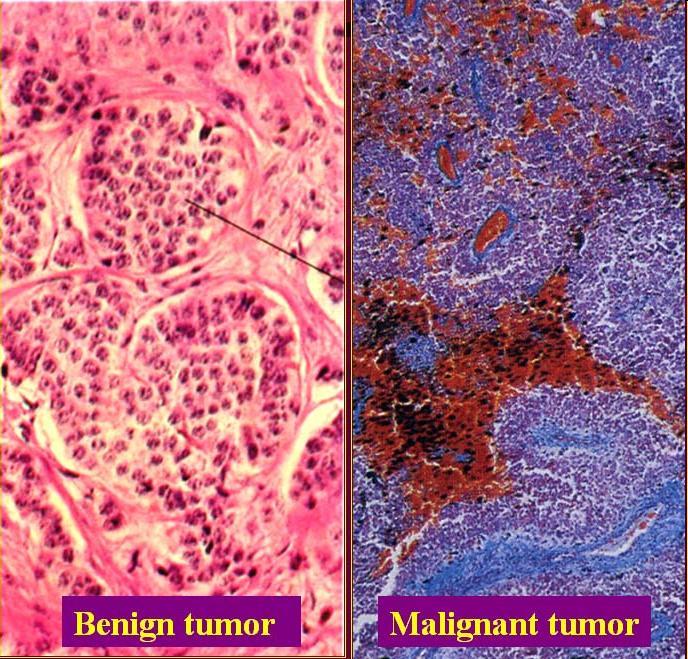 Tumores benignos y malignos Tumor benigno: