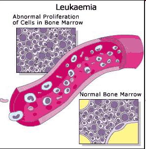 Leucemia y linfoma: el primero es en células de la