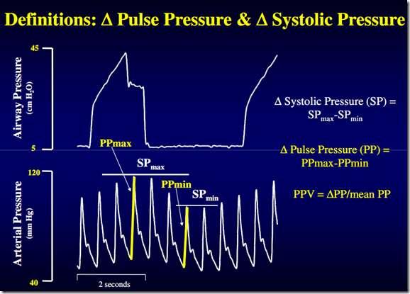Variación de la presión de pulso Una VPP>13% permite discriminar de forma sensible la respuesta a fluidos y la precarga.