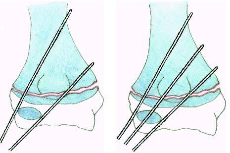 la presencia de lesión iatrogénica del nervio cubital, al intentar el paso del clavo desde el epicondilo medial.