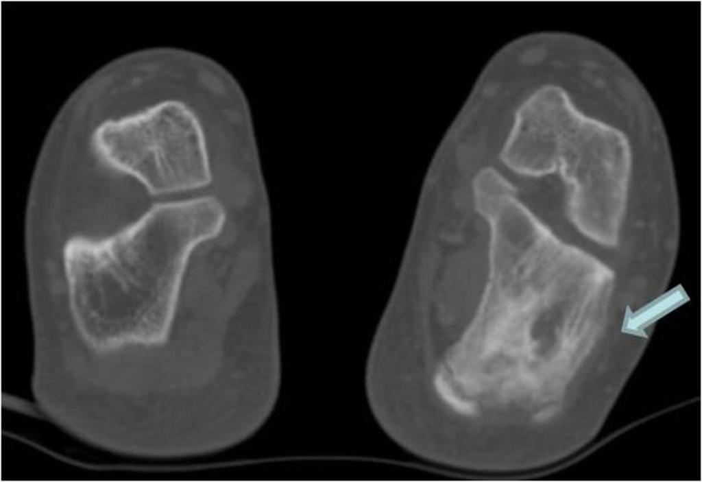 Fig. 2: Aumento de la densidad del calcáneo en relación a esclerosis difusa, con