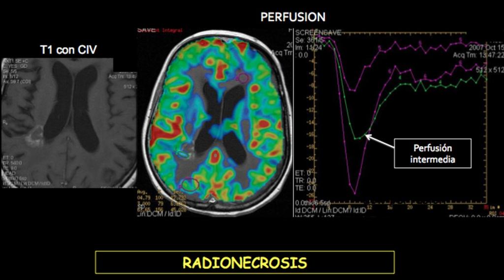 izquierdos. En el estudio de perfusión presentan baja angiogénesis. Indicativo de RADIONECROSIS. Fig. 6: Mujer de 57 años con Astrocitoma frontal izquierdo tras cirugía + radioterapia.