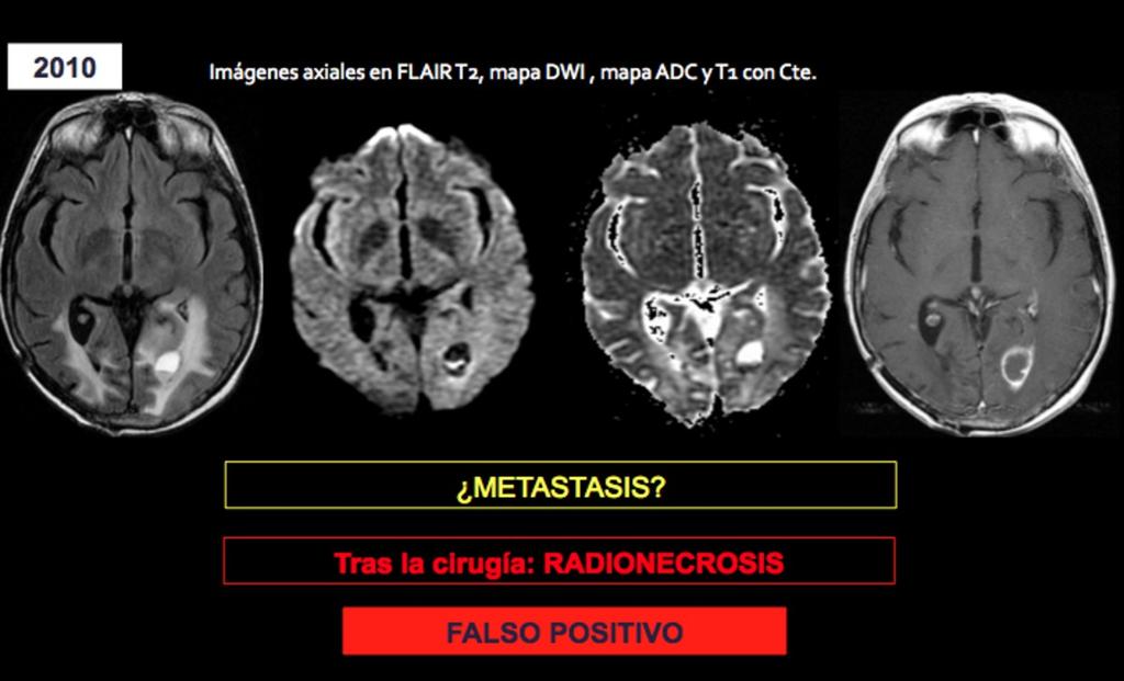 Fig. 15: Varón de 62 años operado de adenocarcinoma de colon en 2004. En 2007 intervenido de metástasis de parieto-occipital derecha + Radioterapia complementaria.