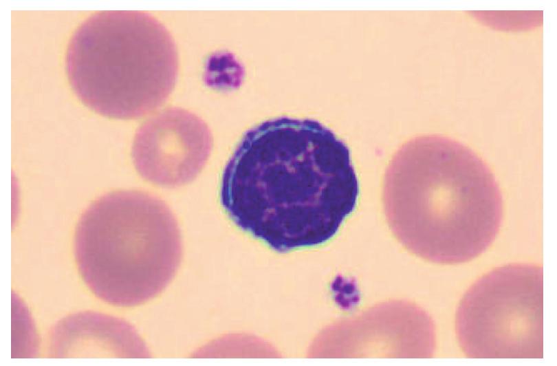Extensión de sangre periférica teñida con May-Grünwald-Giemsa (x 500) en la que se observan abundantes linfocitos de tamaño pequeño y cromatina madura y condensada.
