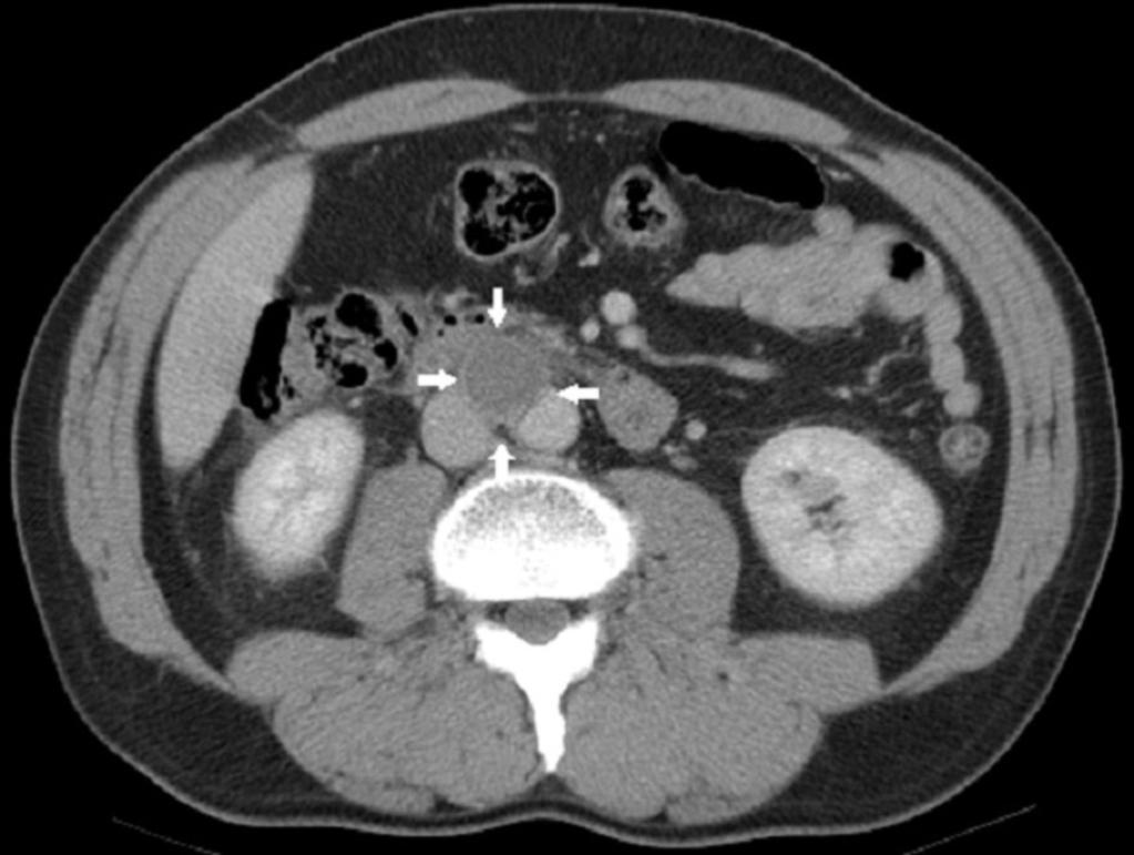 Fig. 7: Paciente 3. TC abdominal con contraste intravenoso. Paraganglioma interaortocava.