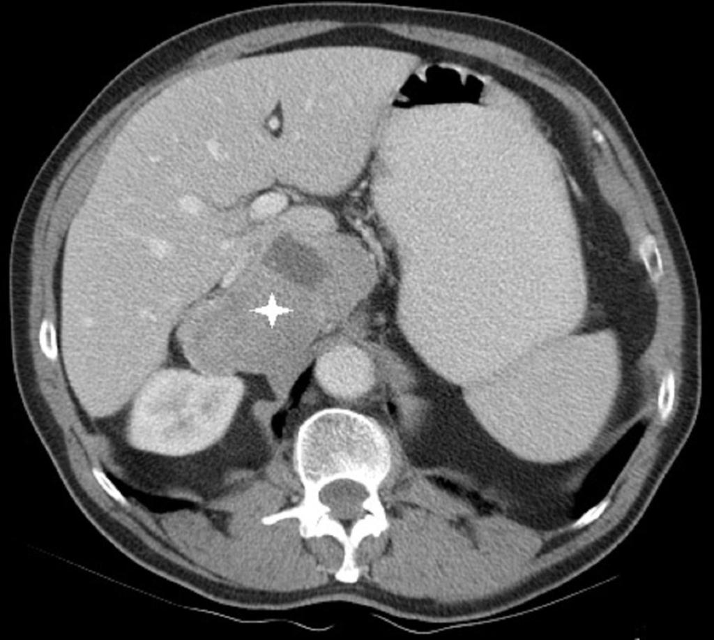 Fig. 1: Paciente 1.TC abdominal con contraste intravenoso. Feocromocitoma suprarrenal derecho maligno.